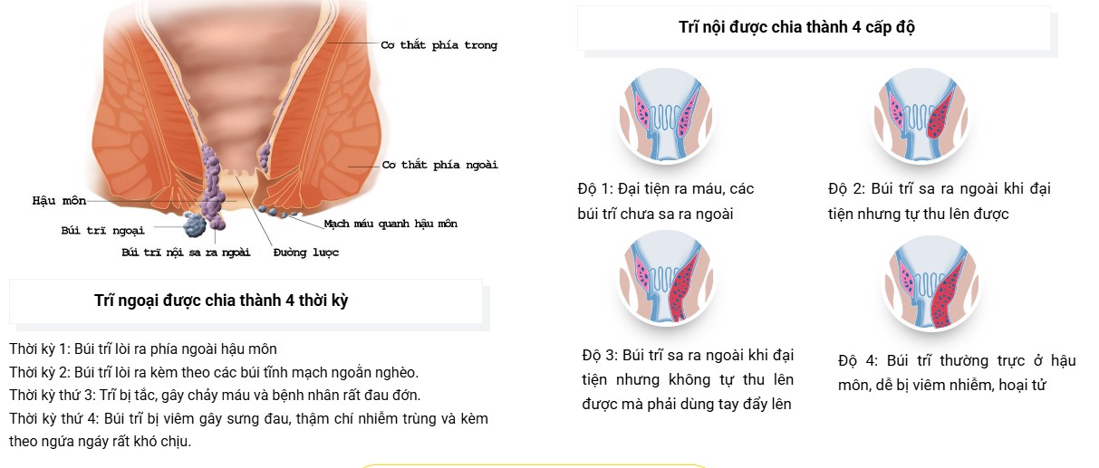 Các cấp độ trĩ
