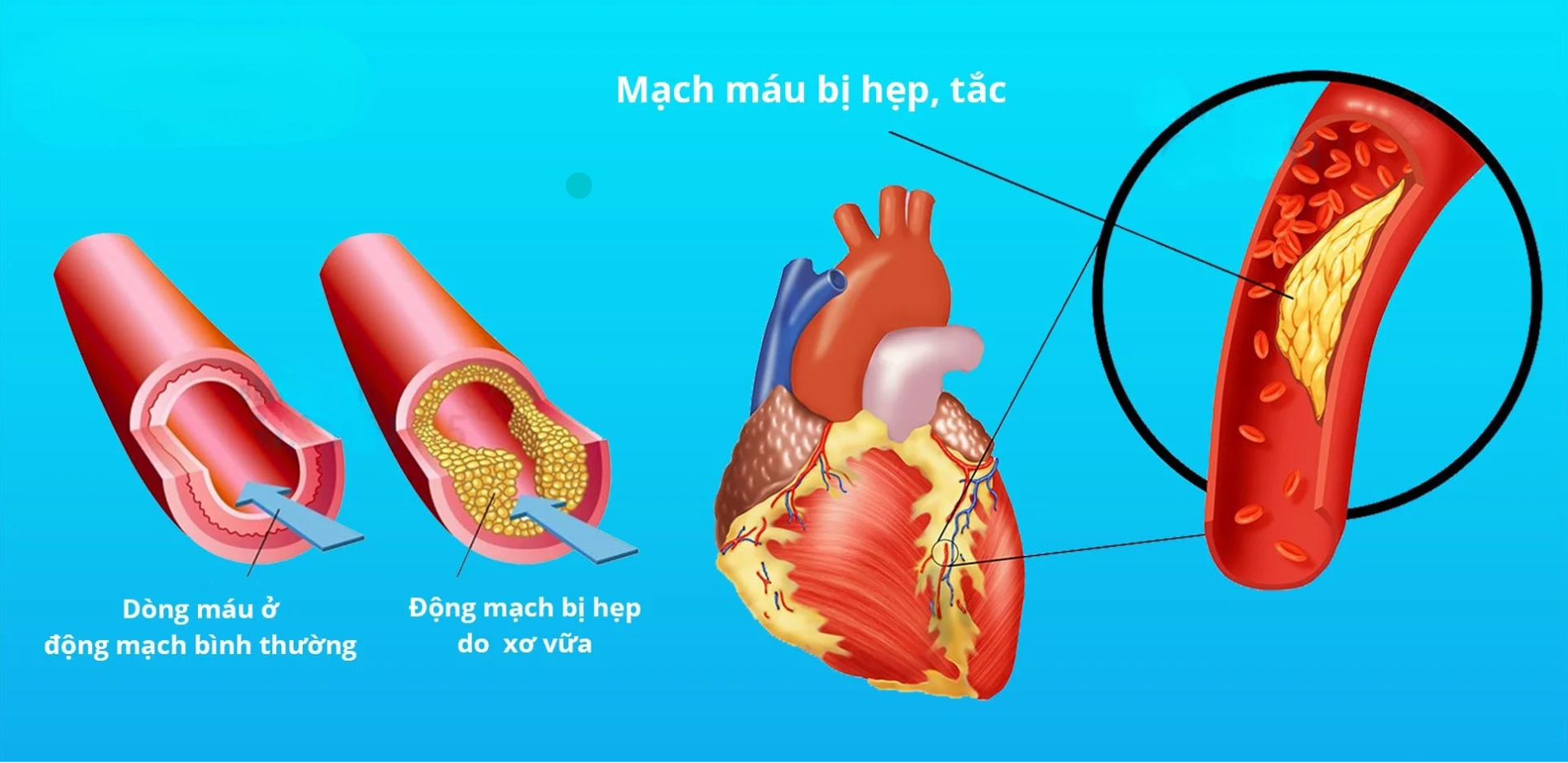 Bệnh Mạch Vành gây rối loạn nhịp tim