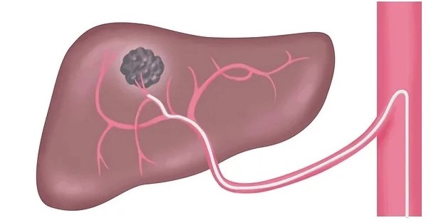 Kỹ thuật thuyên tắc mạch máu