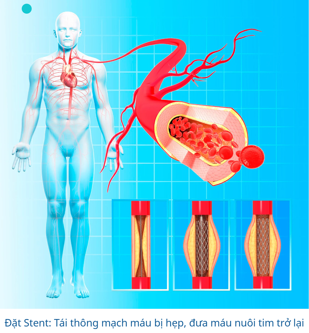 Cách chữa Bệnh Mạch Vành