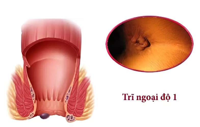 Trĩ Ngoại Độ 1