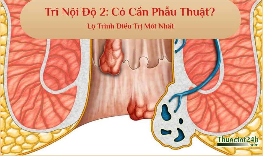 Trĩ độ 2 có cần phẫu thuật không