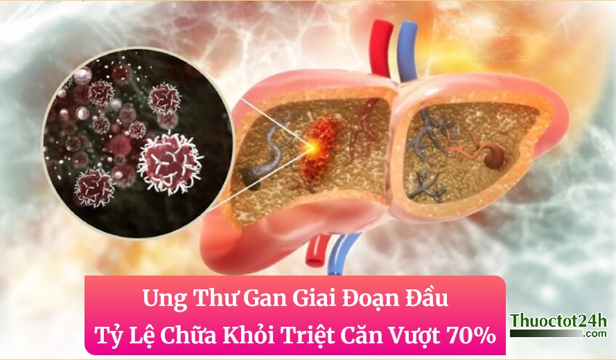 Ung Thư Gan Giai Đoạn Đầu: Tỷ Lệ Chữa Khỏi Triệt Căn Vượt 70%