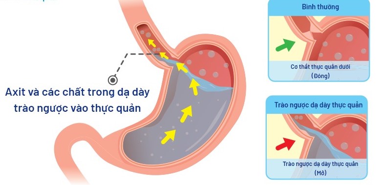 Bệnh dạ dày thực quản