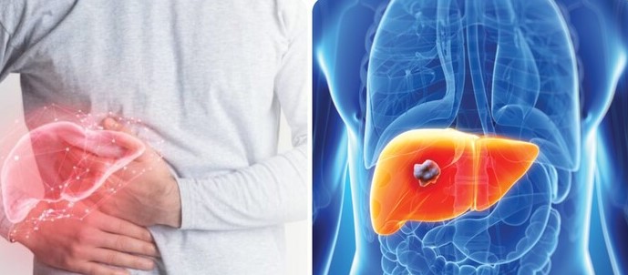 dấu hiệu ung thu gan giai đoạn đầu ít nhận ra