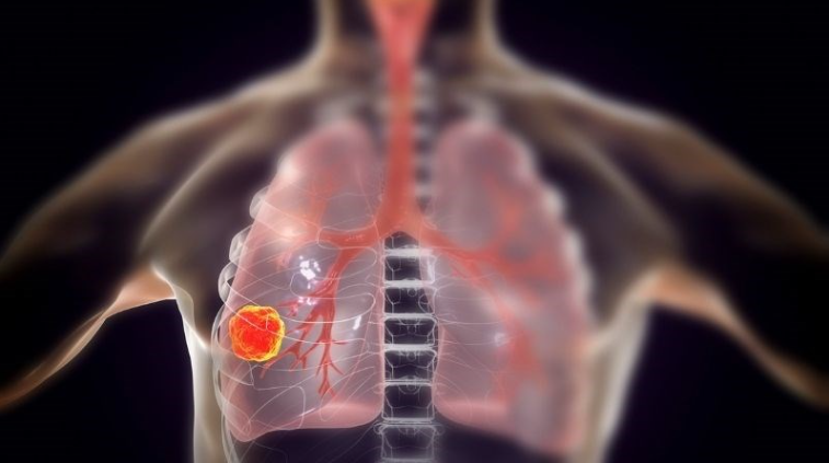 7 dấu hiệu ung thư phổi sớm