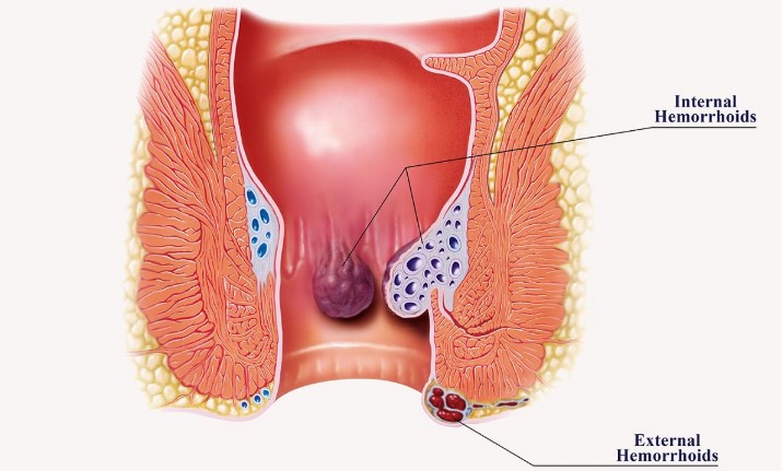 Tự khám trĩ tại nhà