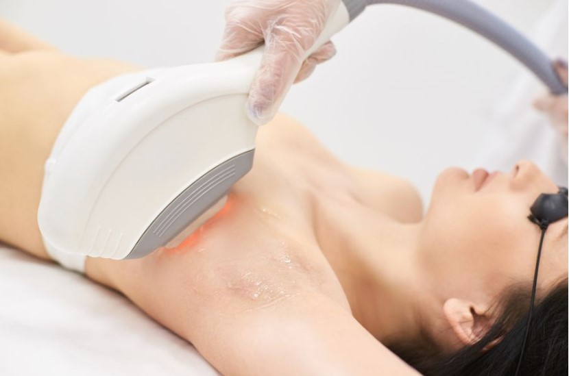 Tần suất triệt lông nách bao lâu