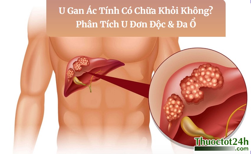 U Gan Ác Tính Có Chữa Khỏi Không? Phân Tích U Đơn Độc & Đa Ổ