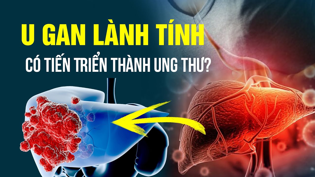 U Gan Lành Tính