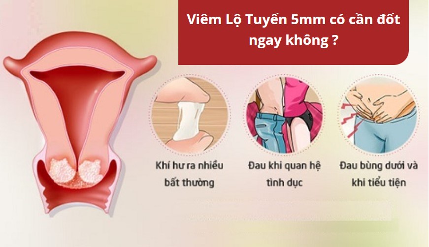 viêm lộ tuyến cổ tử cung 5mm có cần đốt không